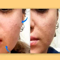 بوتاکس و فیلر نچرال با مواد اصل . فولادشهر