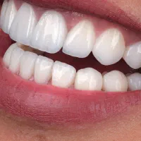 جشنواره ویژه لمینیت دندان