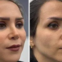 فرمدهی بدن و جوانی صورت با متد جدید