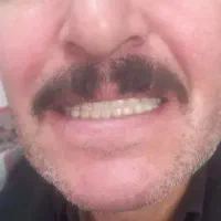 ساخت انواع دندان مصنوعی ایرانی وخارجی