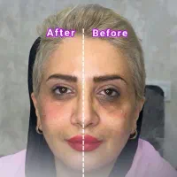 فیلرلب روسی ،گونه و زاویه،بوتاکس، فول فیس،زیرچشم|خدمات آرایشگری و زیبایی|شیراز, ستارخان|دیوار