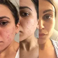 درمان تخصصی جوش های صورت|آرایشی، بهداشتی، درمانی|کرج, شهرک آسمان|دیوار