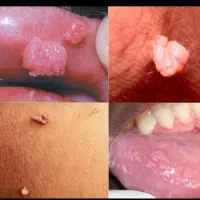 درمان ریشه ای زگیل و تبخال به صورت گیاهی|آرایشی، بهداشتی، درمانی|ساری, |دیوار