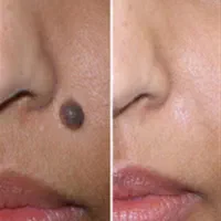 خال برداری و ضایعات پوستی در کلینیک معتبر