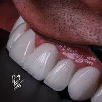 لمینت کامپوزیت ایمپلنت ارتودنسی عصب کشی|خدمات آرایشگری و زیبایی|شیراز, قصرالدشت|دیوار