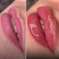 آموزش پیشرفته فیلر(ژل)،بوتاکس،لیفت نخ|خدمات آموزشی|تهران, نیاوران|دیوار