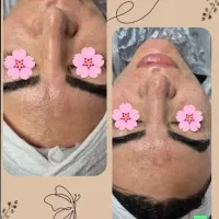 فشیال تخصصی واصلاح تخصصی درماپلینگ|خدمات آرایشگری و زیبایی|بیرجند, |دیوار