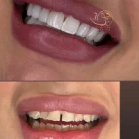 کامپوزیت دندان اقساط بدون پیش پرداخت