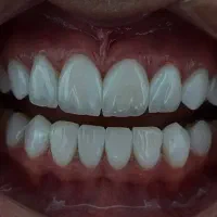دندانپزشکی عصبکشی کامپوزیت
