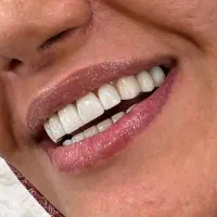 دندانپزشکی.لمینت فقط ۳