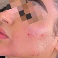 تزریق ژل وفیلر|خدمات آرایشگری و زیبایی|رباطکریم, رباطکریم|دیوار