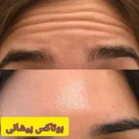 جشنواره ویژه تابستانه بوتاکس