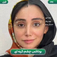 درمان خطوط پیشانی اخم و زیر چشم تک جلسه توسط پزشک