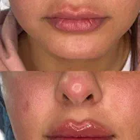 تزریق ژل بوتاکس مزونیدلینگ ، مزوسروابرو ،فیلربادی|خدمات آرایشگری و زیبایی|تهران, نیروی هوایی (پیروزی)|دیوار