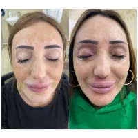 درمان قطعی پیسی،پسوریازیس،اگزما،زیگیل تناسلی