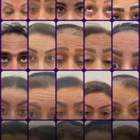 تزریق بوتاکس توسط پزشک