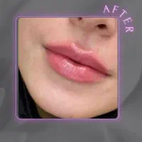ژل و بوتاکس|خدمات آرایشگری و زیبایی|تهران, قلهک|دیوار