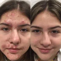 درمان جوش ،جای جوش و لک با دستگاه اکولیفت ،۳۹۰