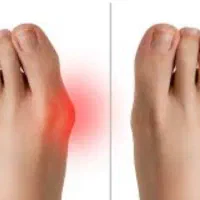 مرکز ارتوپدی درمان هالوکس والگوس (شصت پای کج)