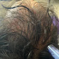 مزوتراپی و مزونیدلینگ مو درمان ریزش مو و رویش مجدد|خدمات آرایشگری و زیبایی|قائم‌شهر, |دیوار