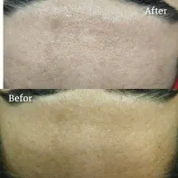 فیشال صورت ،درمان مو ،تزریق ژل صورت|خدمات آرایشگری و زیبایی|کارون, |دیوار