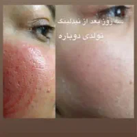 پاکسازی پوست دائمی