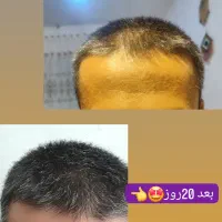 پک طبیعی ریزش مو