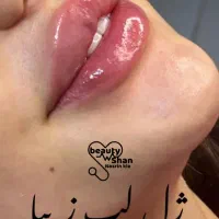 خدمات زیبایی ساکشن و تزریق فیلر های بادی|خدمات آرایشگری و زیبایی|خرمآباد, |دیوار