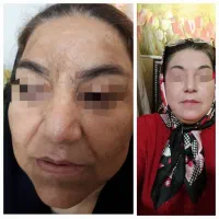 لیزر co2تک جلسه ای،تزریق چربی ودیگر خدمات زیبایی|خدمات آرایشگری و زیبایی|یاسوج, |دیوار