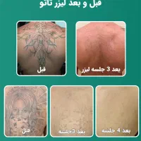 اجاره اتاق مطب برای پاک کردن تتو