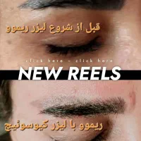 پاک کردن تتو///خدمات لیزر کیوسوئیچ و پیلینگ کربن