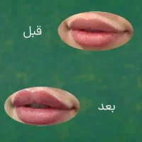 ژل بوتاکس وپاکساسازی پوست