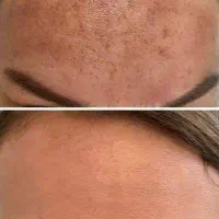 پک تخصصی رفع لک پوستی