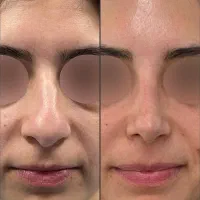 عمل بینی قسطی فقط با ماهی 4م|خدمات آرایشگری و زیبایی|تهران, سهروردی|دیوار