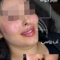 فیلر.ژل لب.طراحی و لیفت لب روسی توسط متخصص