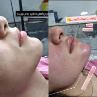 زیبایی ماندگار آرایش دائم / تزریق ژل و بوتاکس|خدمات آرایشگری و زیبایی|شوشتر, |دیوار