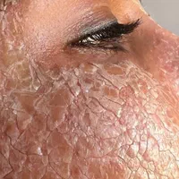 تخفیفات عیدانه فشیال بوتاکس مزو