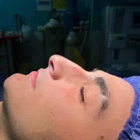 جراحی بینی|خدمات آرایشگری و زیبایی|قائم‌شهر, |دیوار