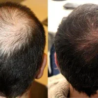 راهکارهای نوین برای افزایش پرپشتی