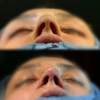 تخفیف عمل بینی،رفع غبغب لیپو،ابدو،لیفت،دایرکت ابرو|خدمات آرایشگری و زیبایی|آمل, |دیوار