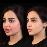 تزریق ژل و بوتاکس فقط ۵۰۰هزارتومان