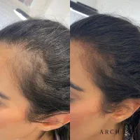 درمان ریزش مو ورشد مجدد مو|آرایشی، بهداشتی، درمانی|زنجان, |دیوار