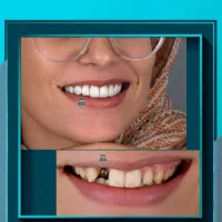پیشنهادویژه عصبکشی دندان درپایتخت دندانپزشکی شیراز