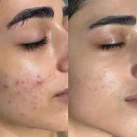 فیشیال و پاکسازی تخصصی پوست(جشنوراه)