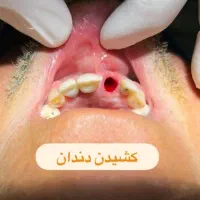 ایمپلنت دیجیتال دندان از دم اقساط اوردنچر کاشت|خدمات آرایشگری و زیبایی|تهران, قیطریه|دیوار