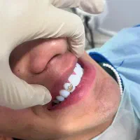 کامپوزیت دندان  به مدت  یک هفته 14 میلیون