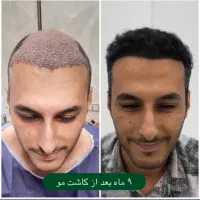 کاشت مو یا معجزه.خط رویش طبیعی تراکم بالا تضمینی|خدمات آرایشگری و زیبایی|یزد, |دیوار