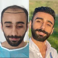 کاشت مو و ابرو و ریش بدون جراحی تراکم بالا|خدمات آرایشگری و زیبایی|تهران, الهیه|دیوار