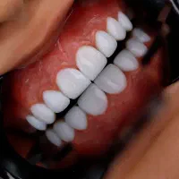 کامپوزیت لمینیت عصب کشی تخصصی
