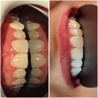 دندانپزشکی اقساطی ۲۰ماه